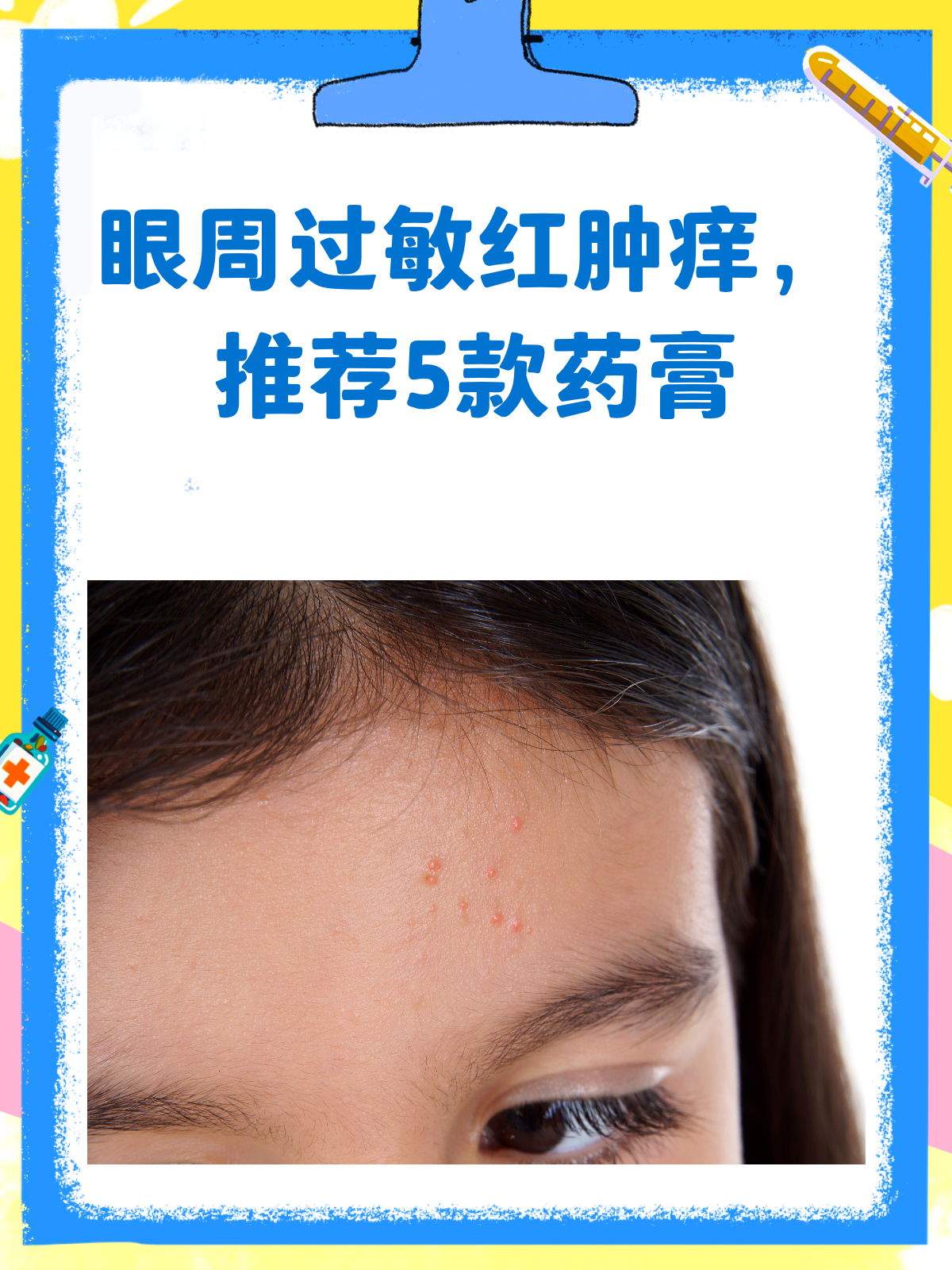 眼周过敏红肿痒?这些药膏来帮忙