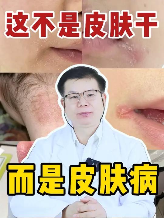 别什么都以为是皮肤干!这是皮肤病!