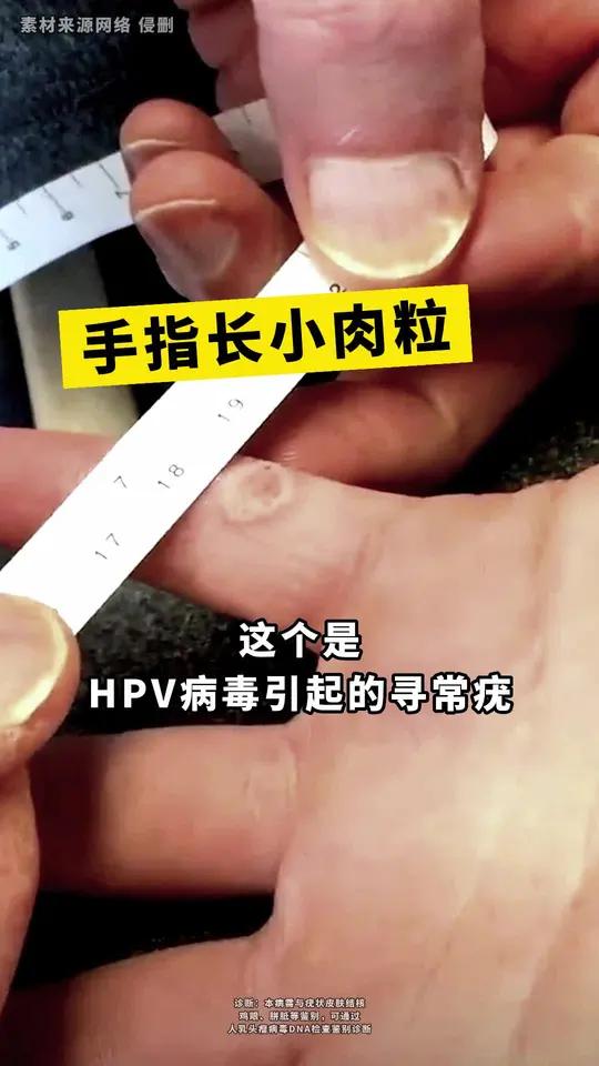 手上长小疙瘩,别用剪刀剪,三甲医生教你正确处理