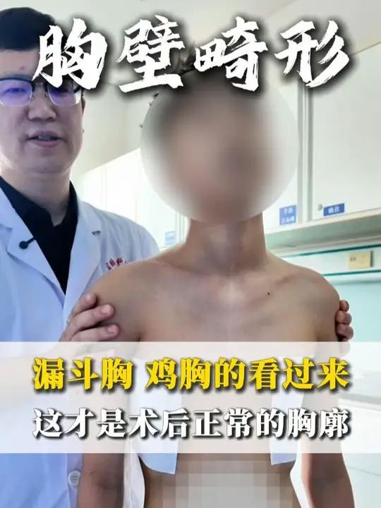 漏斗胸、鸡胸的看过来，这才是术后正常的胸廓 #漏斗胸 #鸡胸 #胸外科 #胸壁畸形#医学科