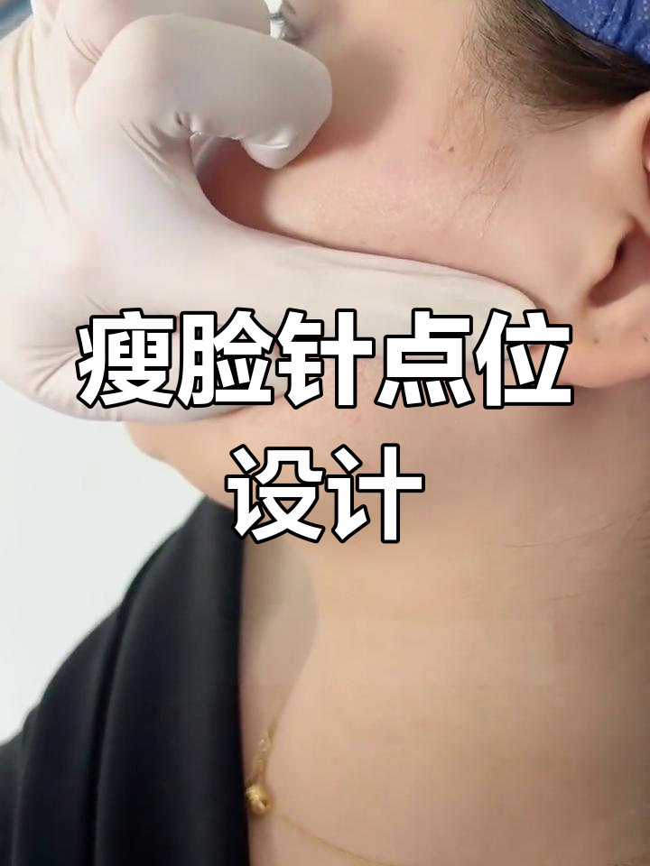 肉毒素注射咬肌的精准定位