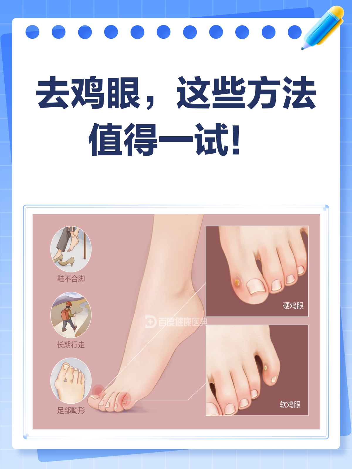 去鸡眼哪种方法最快?看医生怎么说