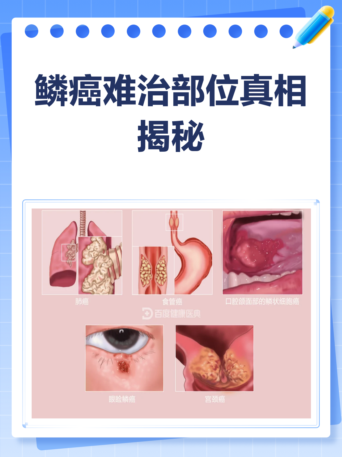 鳞癌哪个部位最难治?一文揭秘!