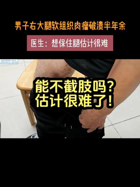 男子大腿软组织肉瘤破溃超过半年,两年前曾在外院接受手术,现需借当时病理玻片进行会诊以进一步