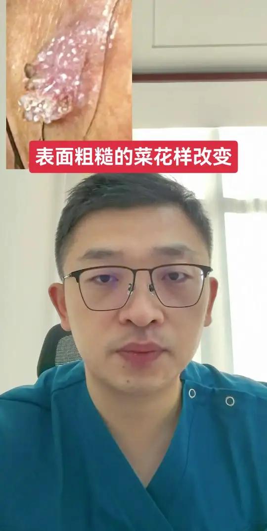 粗糙的菜花样改变