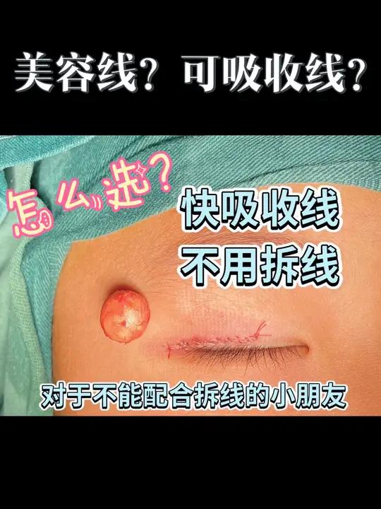 美容线?可吸收线?怎么选择?