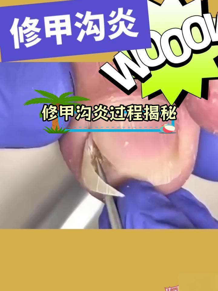 甲沟炎修脚全过程,痛苦与治愈并存