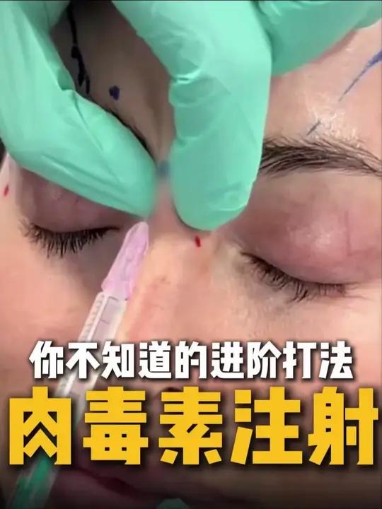 1分钟告诉你肉毒进阶打法，改善80%的面部问题 肉毒素
