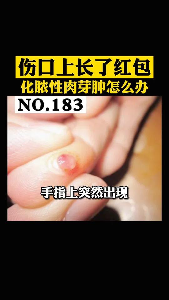 伤口上长了一个红包,可能是这个原因