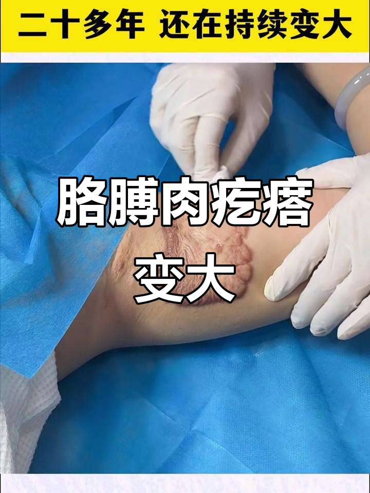 胳膊上的肉疙瘩,20年越长越大,不痛不痒