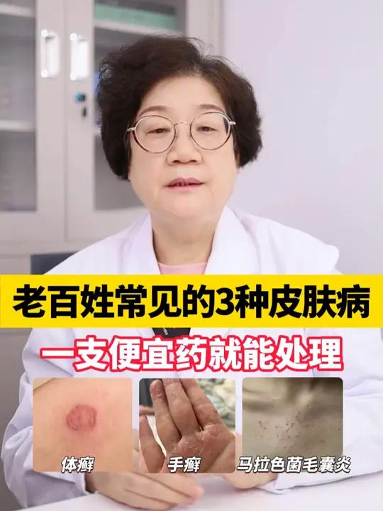 这3种会传染的皮肤病,一支便宜药就能处理!