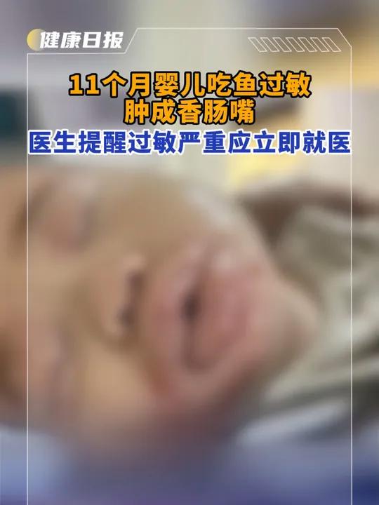 11个月婴儿吃鱼过敏肿成香肠嘴,医生提醒过敏严重应立即就医。过敏 鱼