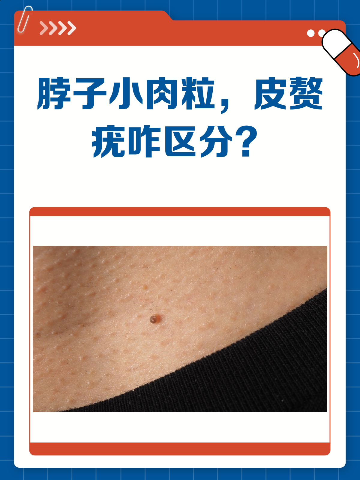 脖子长小肉粒皮赘or疣,一文教你分清