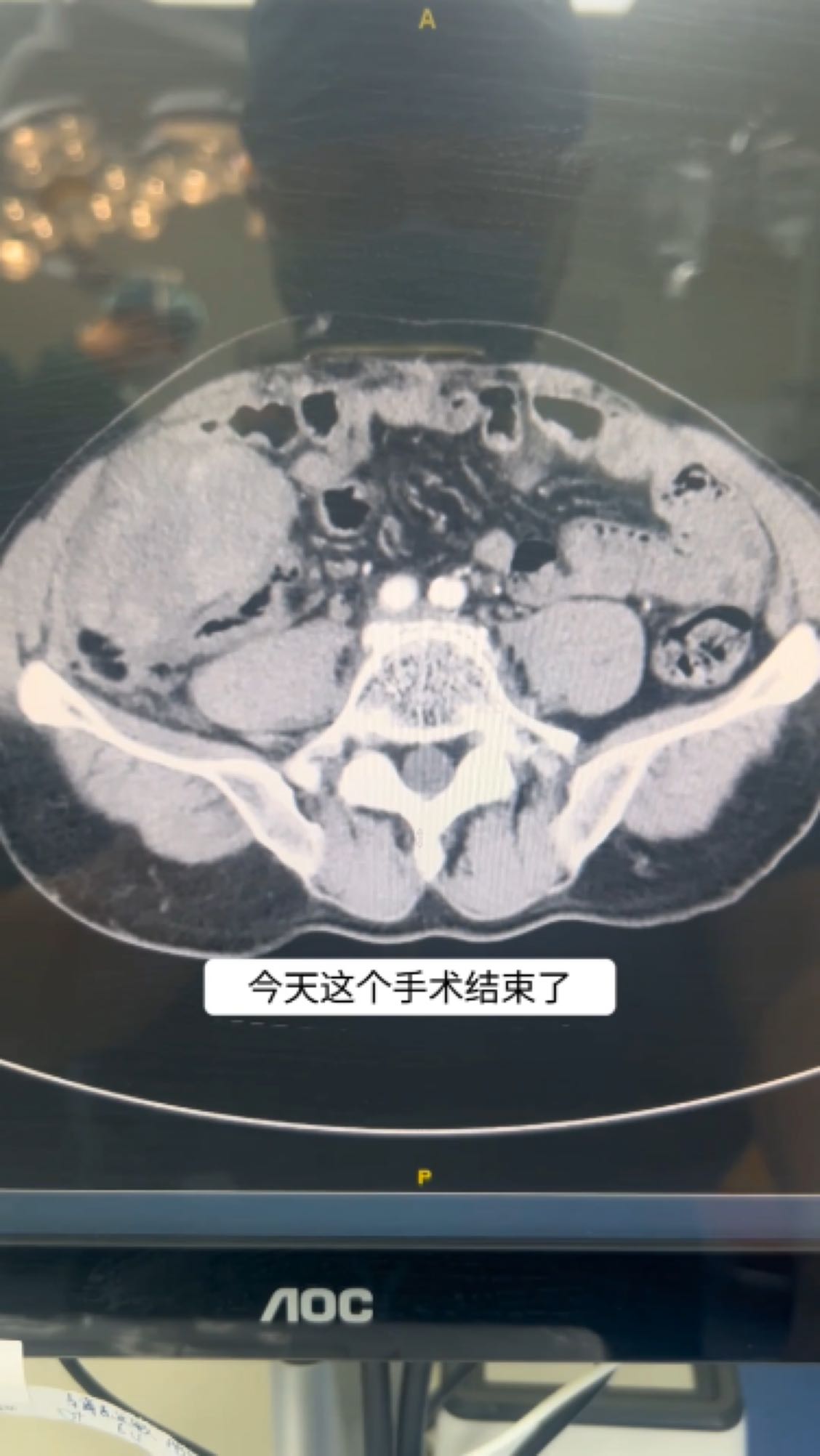 腹膜后脂肪肉瘤复发并侵犯右髂血管及膀胱,完全切除