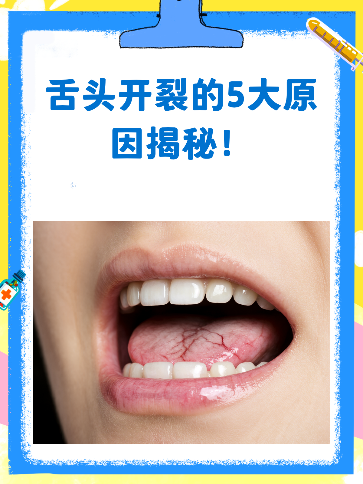 舌头开裂是咋回事?原因可能在这儿!
