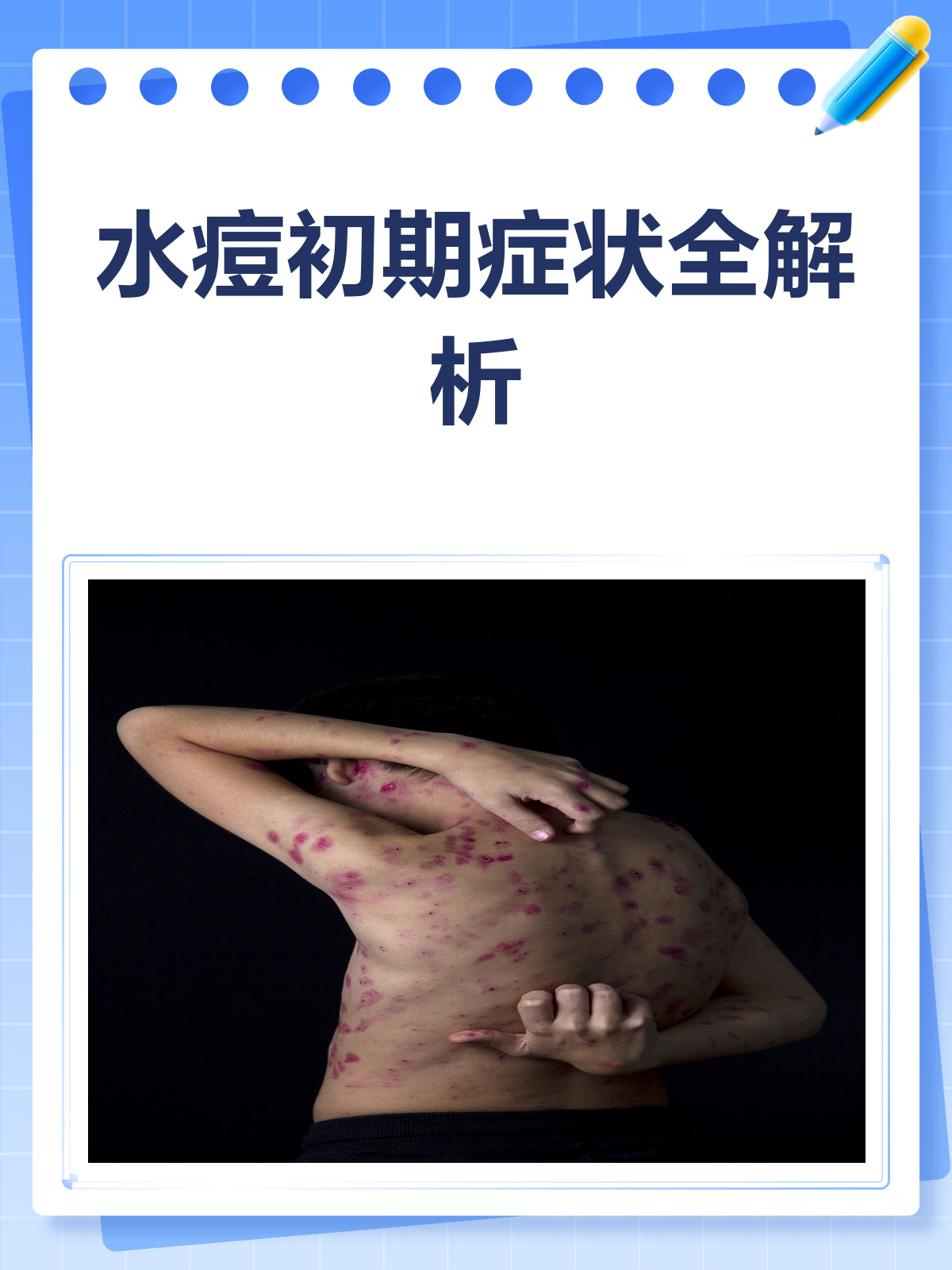 水痘初期症状大揭秘!你中招了吗?