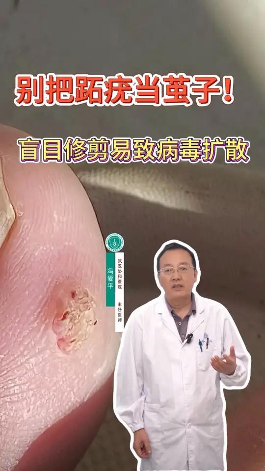 脚上长的这种小疙瘩,可别以为是普通茧子!这其实是跖疣!