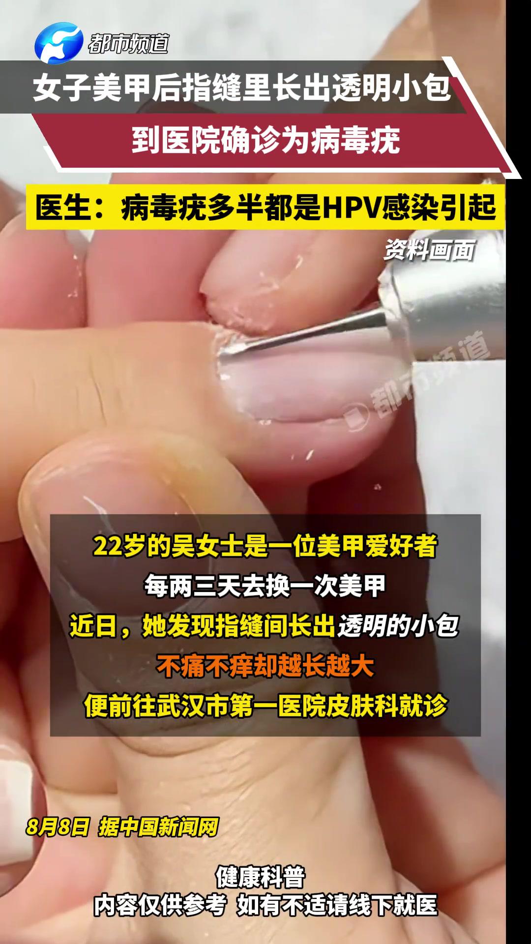 22岁女子美甲后指缝里长出透明小包,到医院确诊为病毒疣。医生:病毒疣多半都是HPV感染引起