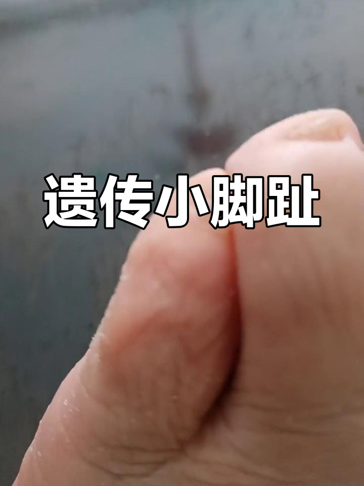小脚趾没有指甲，只有肉疙瘩？老人说这是遗传