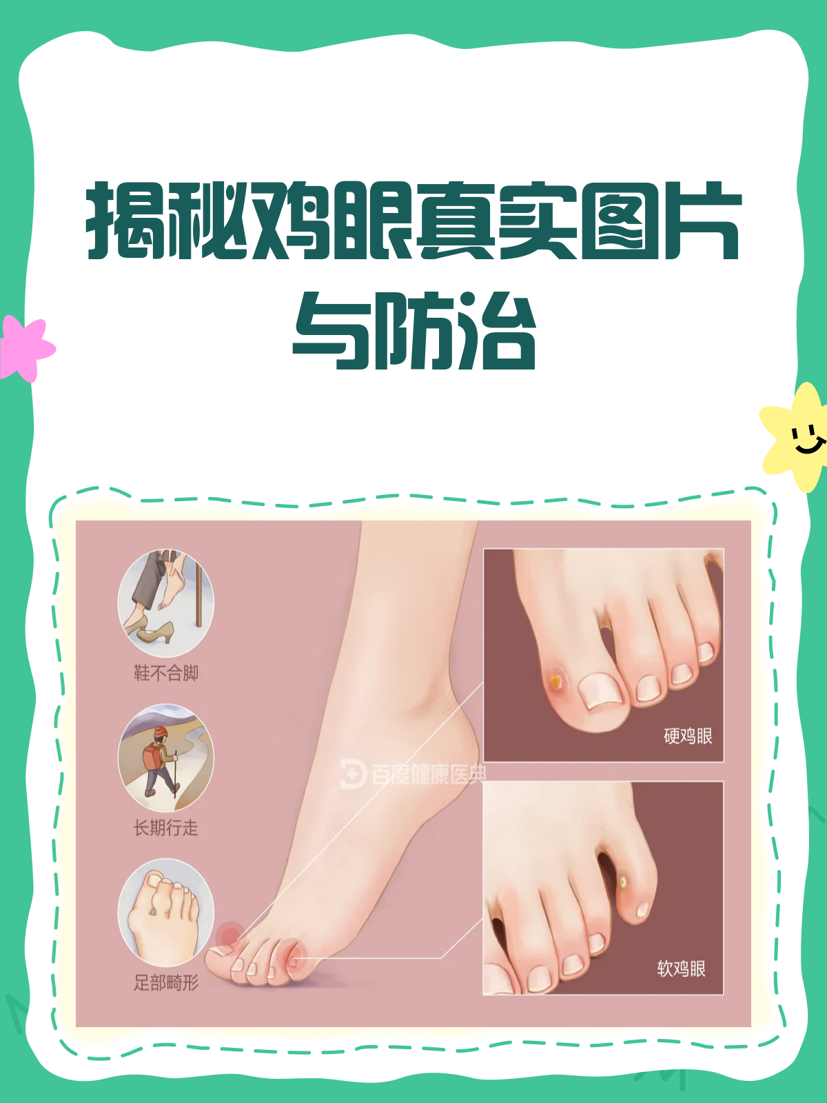 鸡眼长啥样？一篇文章带你认清！