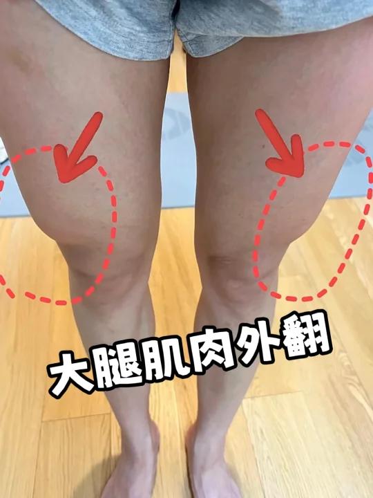 改善大腿肌肉发达外翻修饰腿部线条