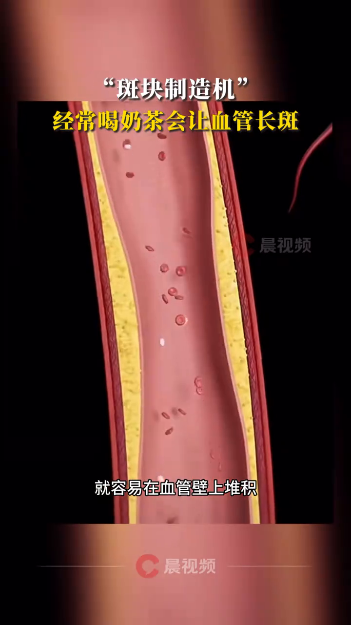 “斑块制造机”经常喝奶茶可能会让你的血管长斑