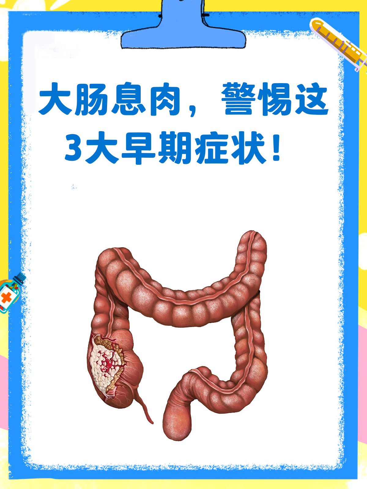 大肠息肉悄然而至?早期信号别忽略!