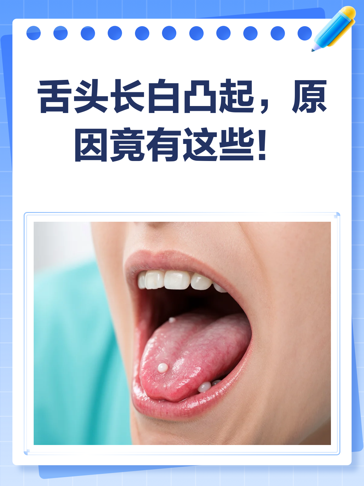 舌头上白色凸起物?别急,一文帮你解惑!