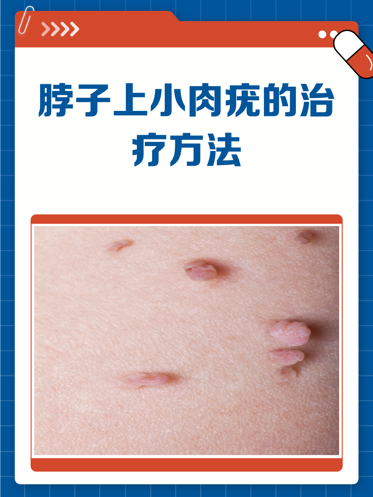 脖子上的小肉疣太烦人？教你几招轻松搞定！