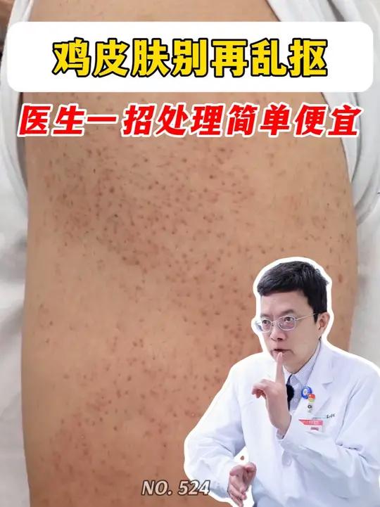 身上的鸡皮肤很难看怎么办?别瞎抠,试试医生的这个方法,简单又便宜!鸡皮肤 毛周角化