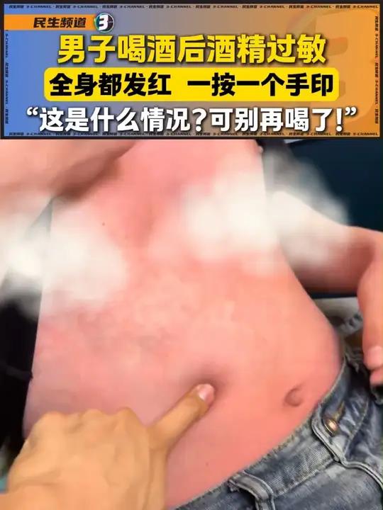 男子喝酒后酒精过敏,全身都发红,一按一个手印……“这是什么情况?可别再喝了!”