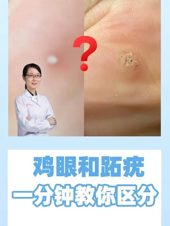 一分钟教你区分趾疣和鸡眼鸡眼跖疣hpv 回复