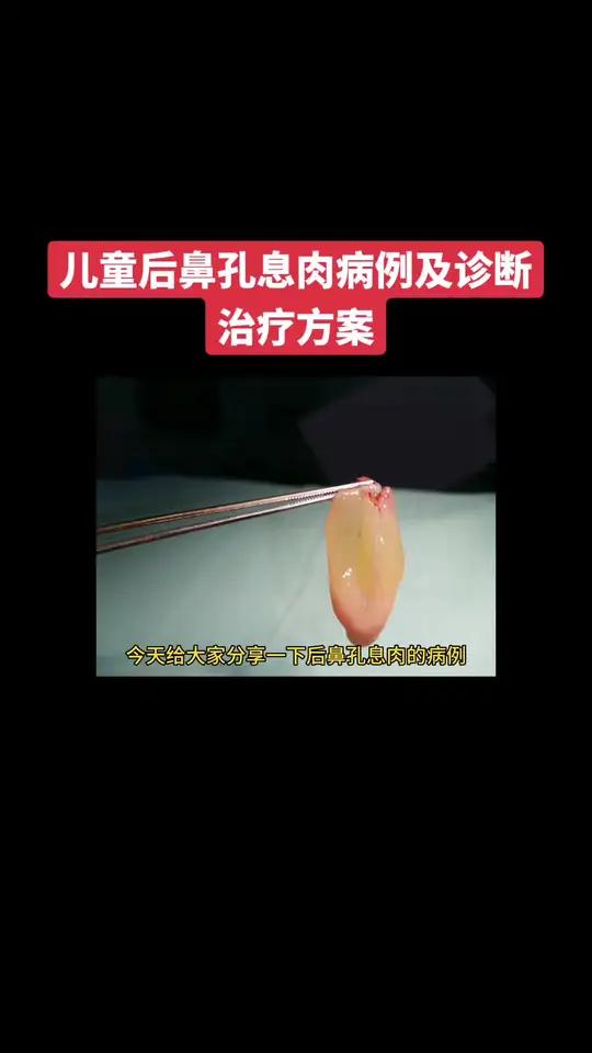 儿童后鼻孔息肉病例分享及诊断治疗方案。晶莹剔透的鼻息肉看起来很美,但可以引起睡眠打鼾及憋气
