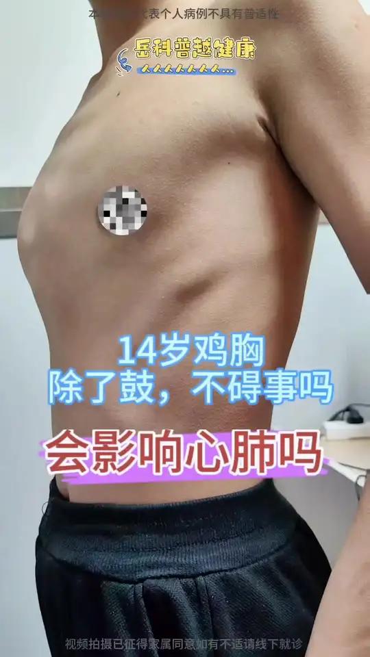 儿童胸外岳芳 胸外科岳芳14岁鸡胸,除了鼓,会碍事吗?