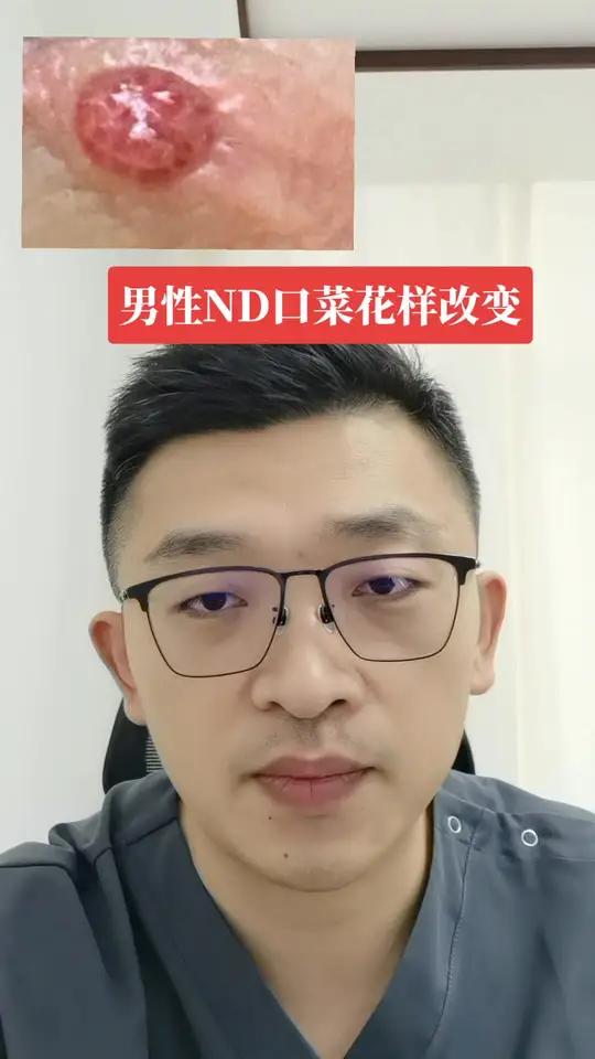 男性尿道口菜花样改变