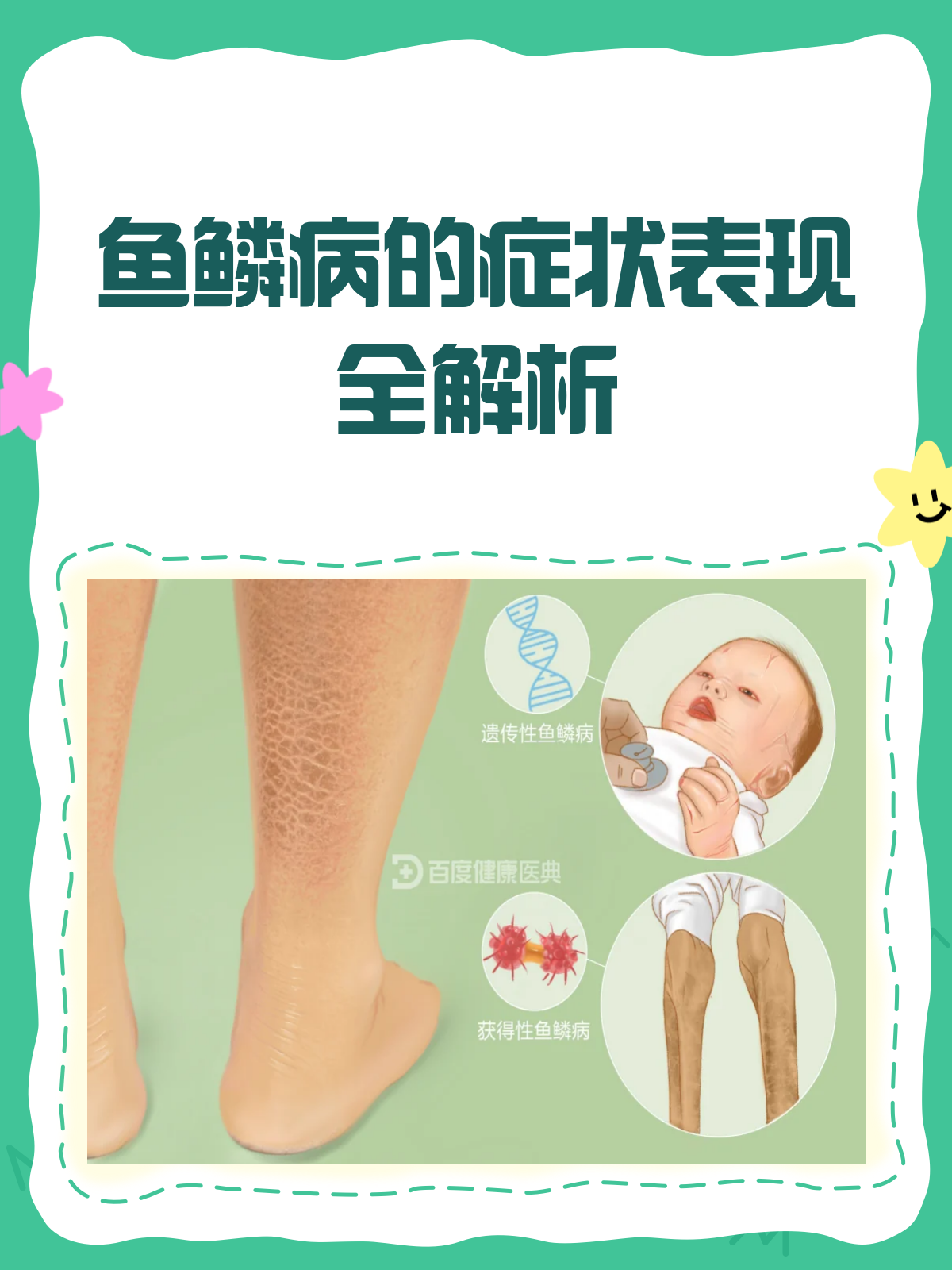 鱼鳞病长啥样？一文带你全面了解