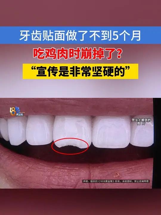 「2万多做牙贴面项目,不到5个月,吃鸡肉时碎了一块?」罗女士反映,她的牙齿贴面才做了不到五