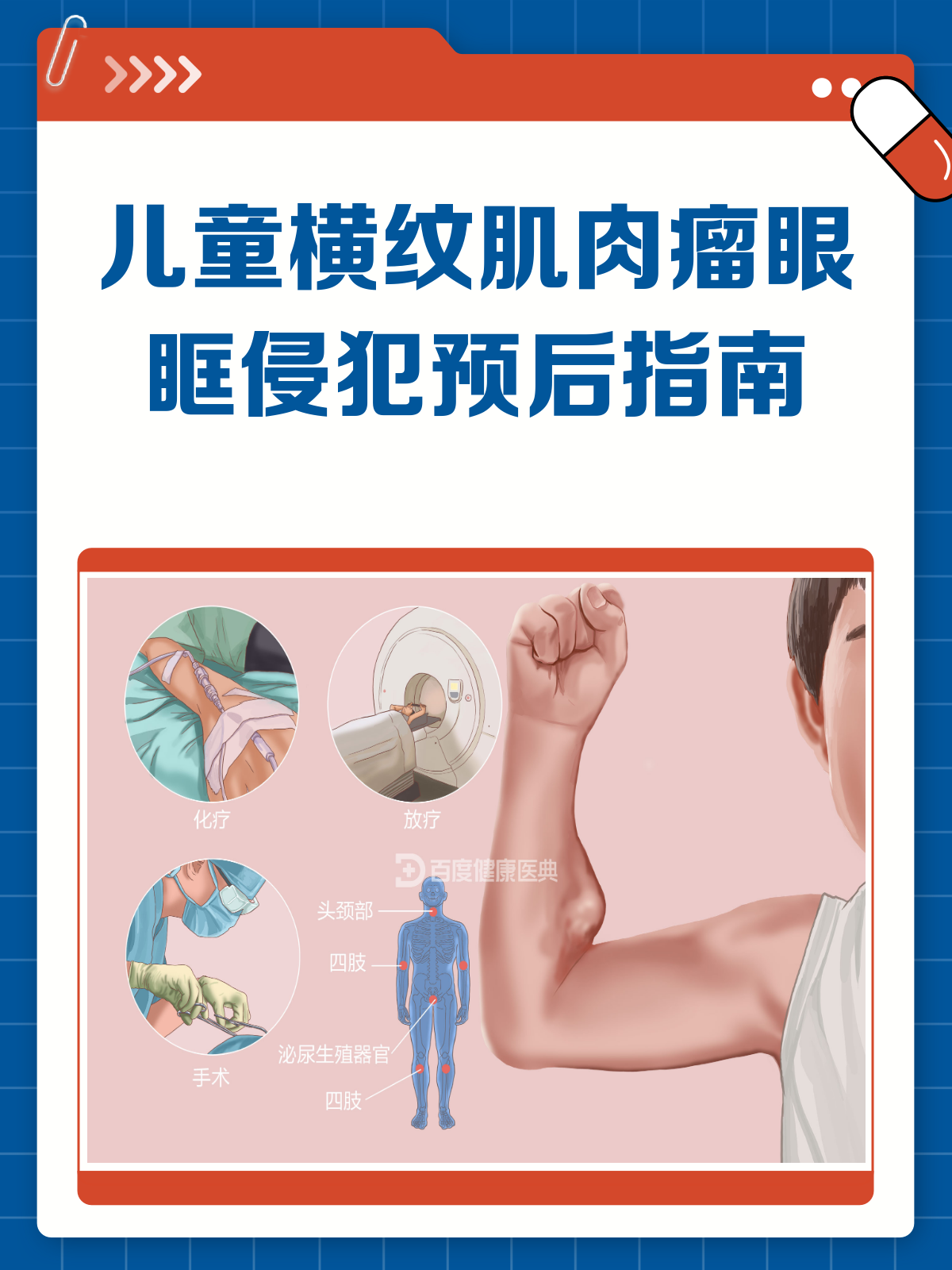 儿童横纹肌肉瘤眼眶侵犯,预后知多少?