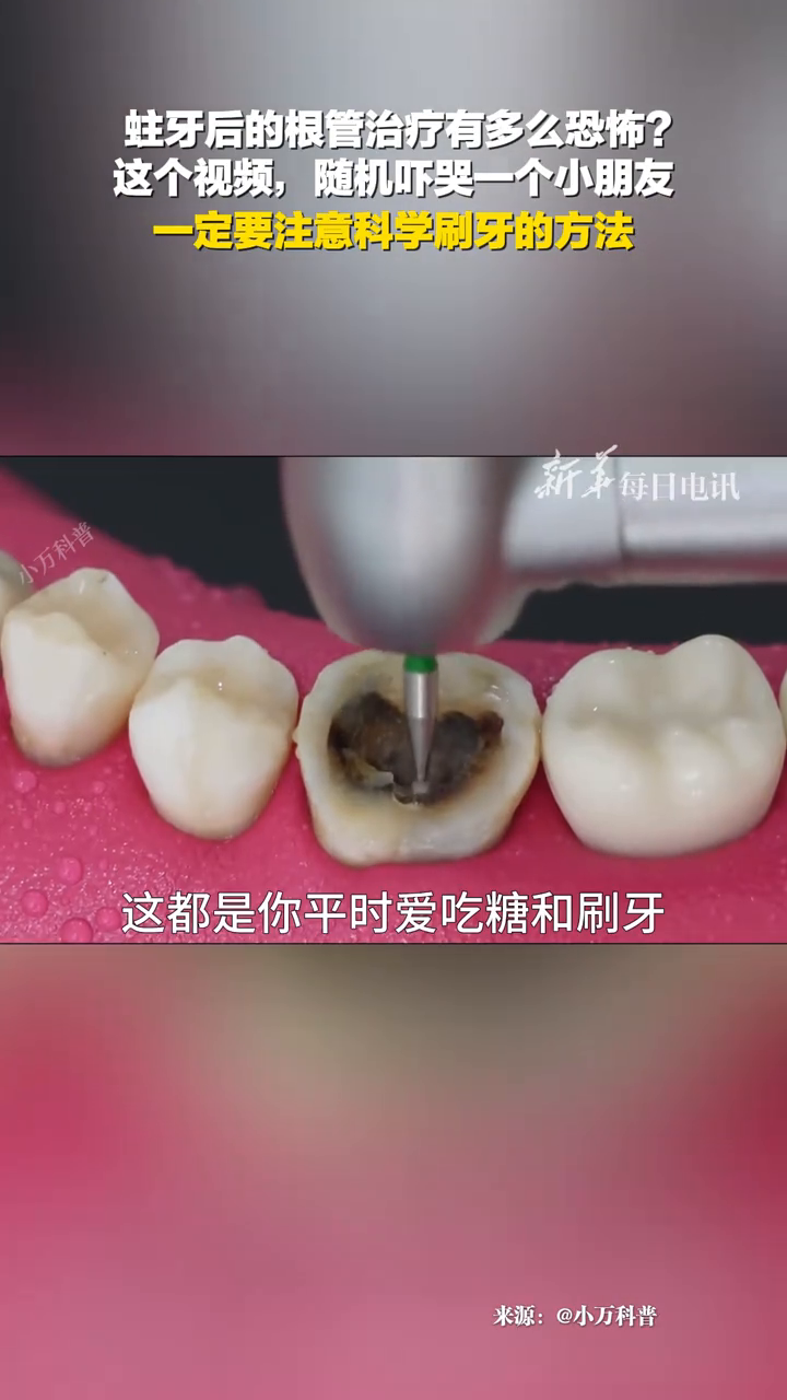 蛀牙后的根管治疗有多么恐怖?这个视频,随机吓哭一个小朋友
