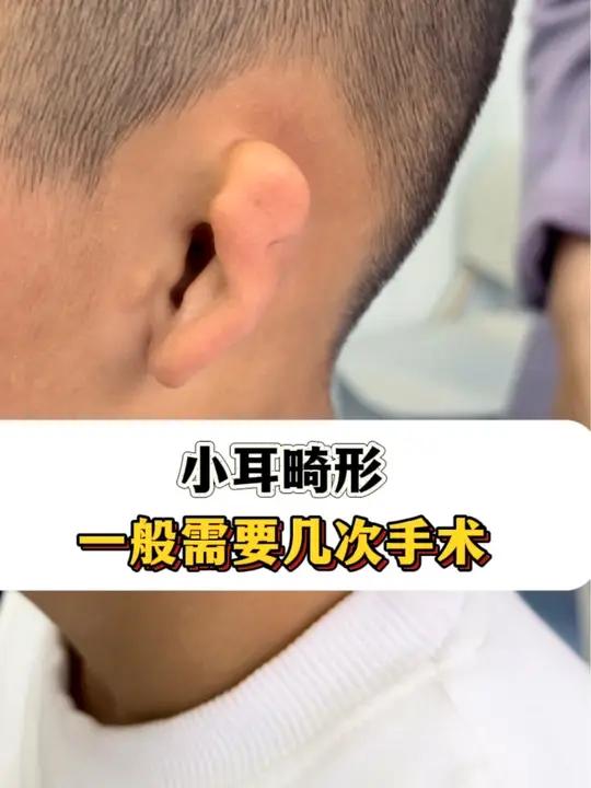 #小耳畸形