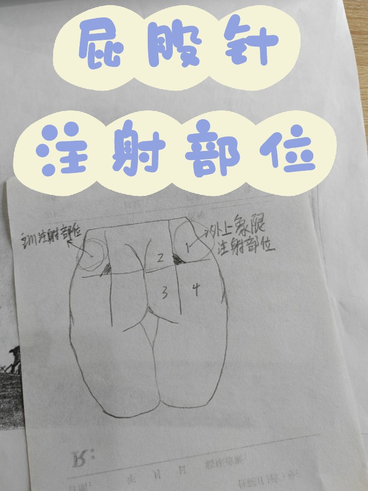 肌肉注射,十字定位法