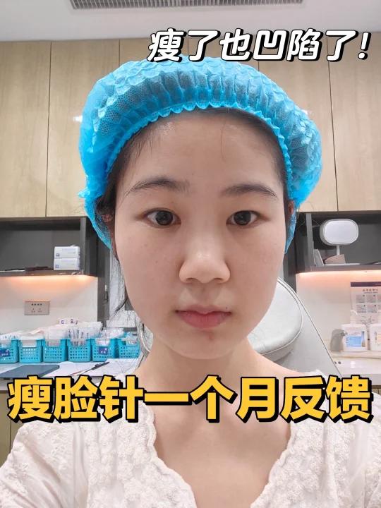 肉肉脸|人生第一次打瘦脸针