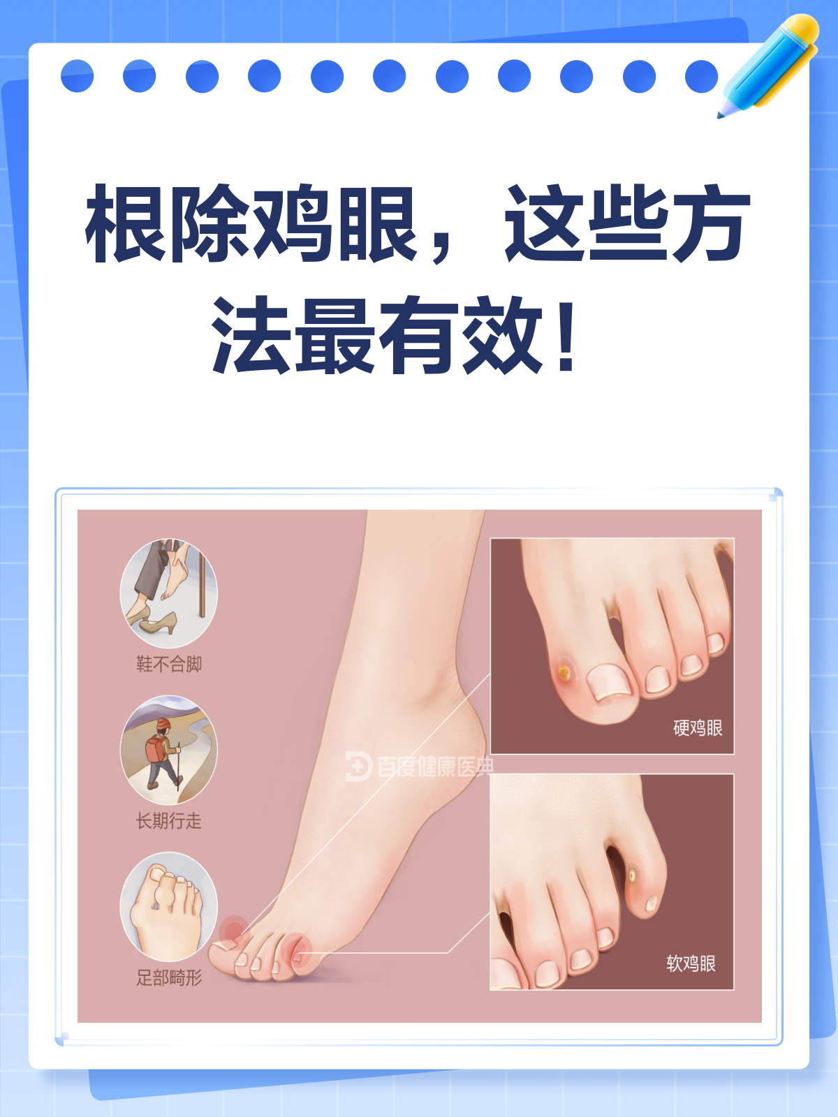 鸡眼怎么治疗能根除?看这里!