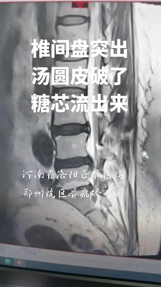 腰椎间盘突出像汤圆皮缺损糖心流出来