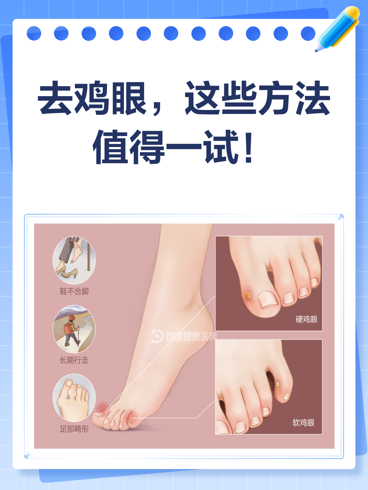 去鸡眼哪种方法最快？看医生怎么说