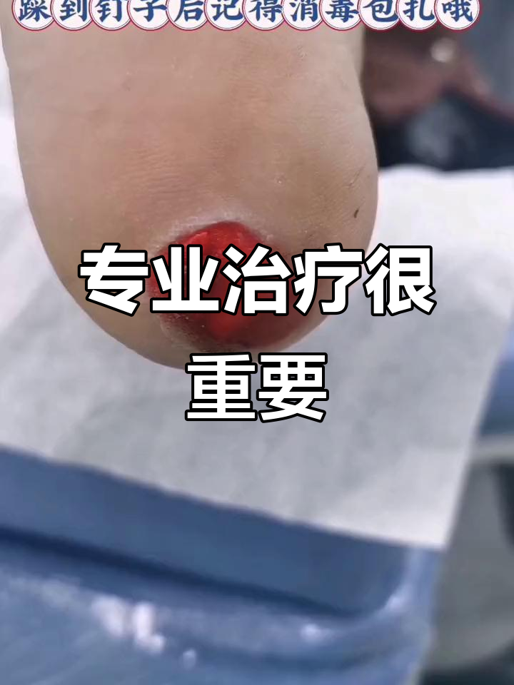 手足问题别乱治,鸡眼膏让阿姨走路都难了