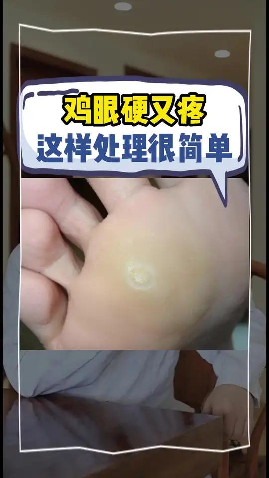 鸡眼别再自己挖了,反复出血还不一定好