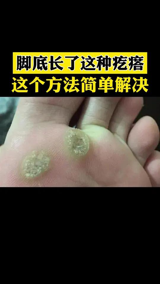 脚上长这种灰黄的小疙瘩,中间还有小黑点,这是hpv引起的哦