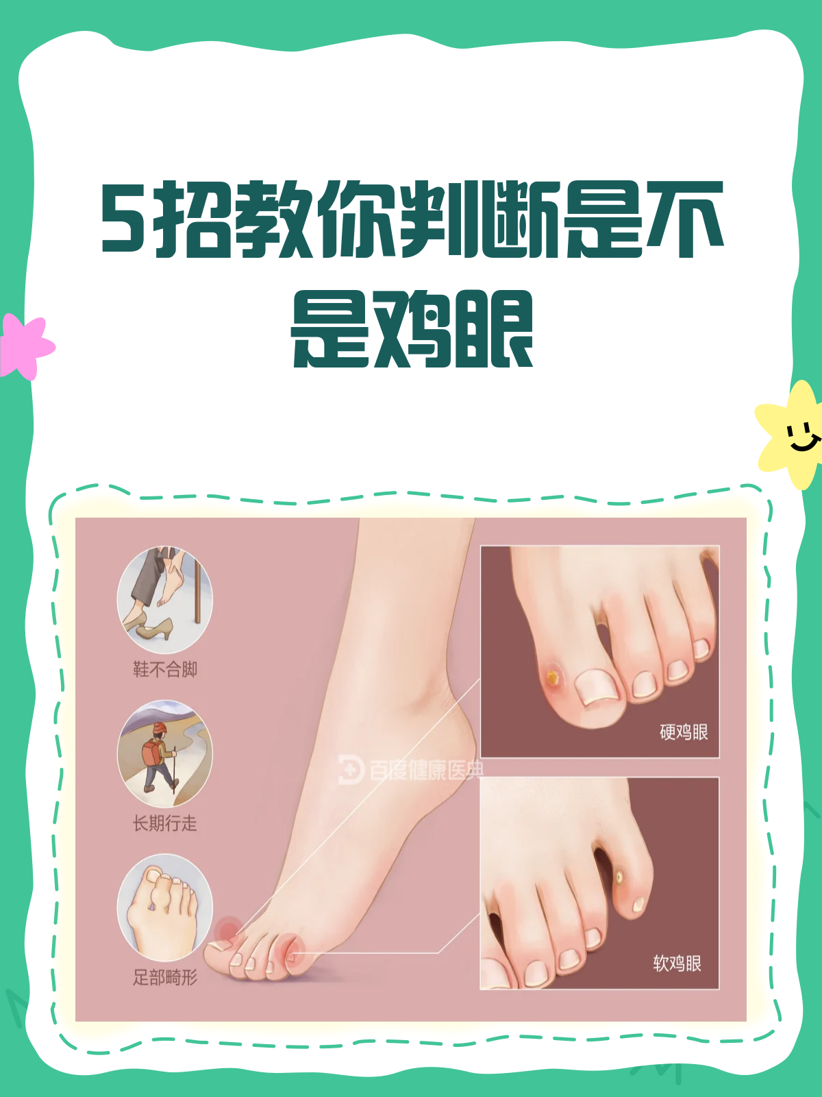 脚底长硬块？教你5招判断是不是鸡眼！