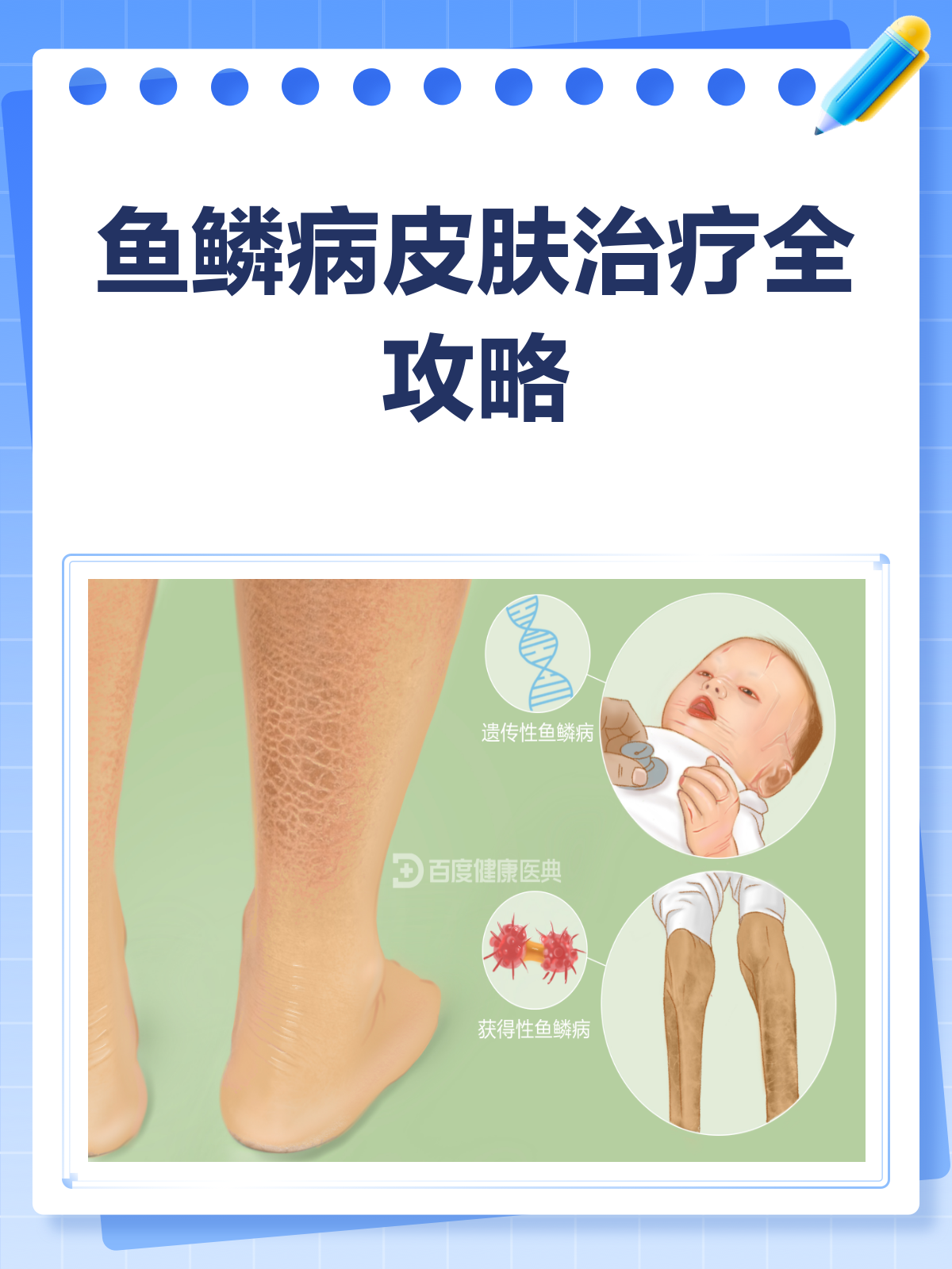 鱼鳞病皮肤别烦恼，全面攻略来帮你